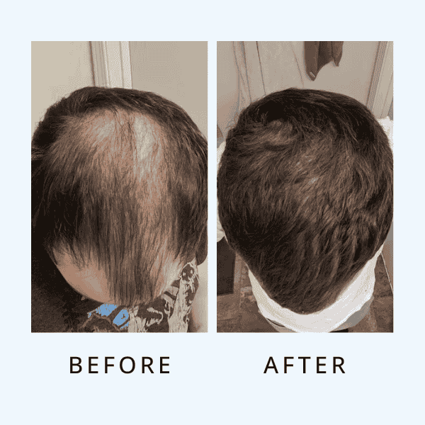 Luxe Hair Growth Serum For Men ( bogo)