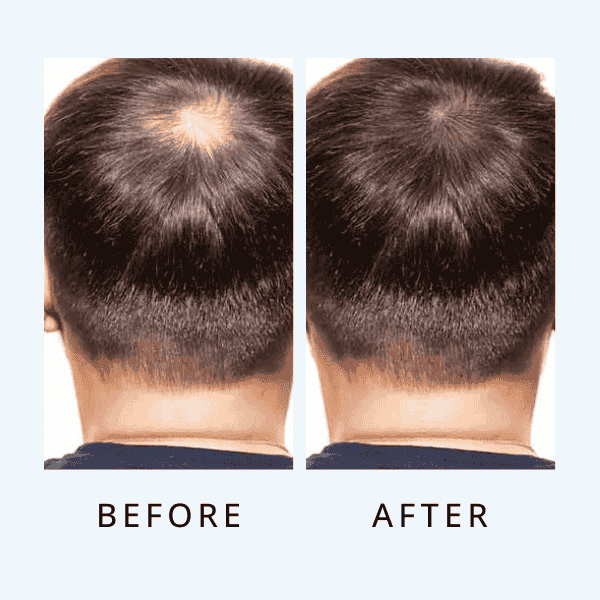 Luxe Hair Growth Serum For Men ( bogo)