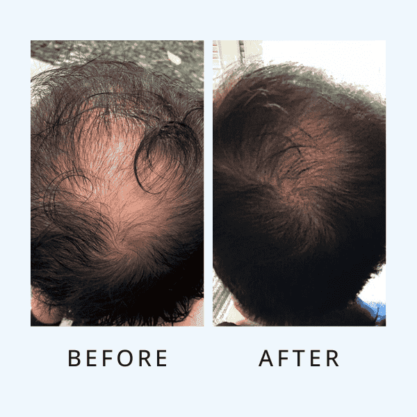 Luxe Hair Growth Serum For Men ( bogo)