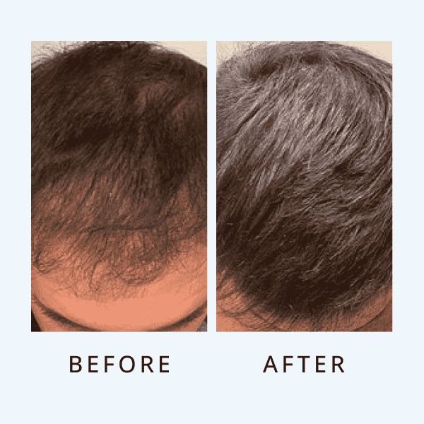 Luxe Hair Growth Serum For Men ( bogo)